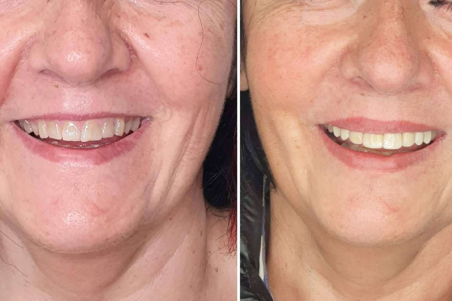 Conseguir una sonrisa Hollywood gracias a los servicios de Dentinova
