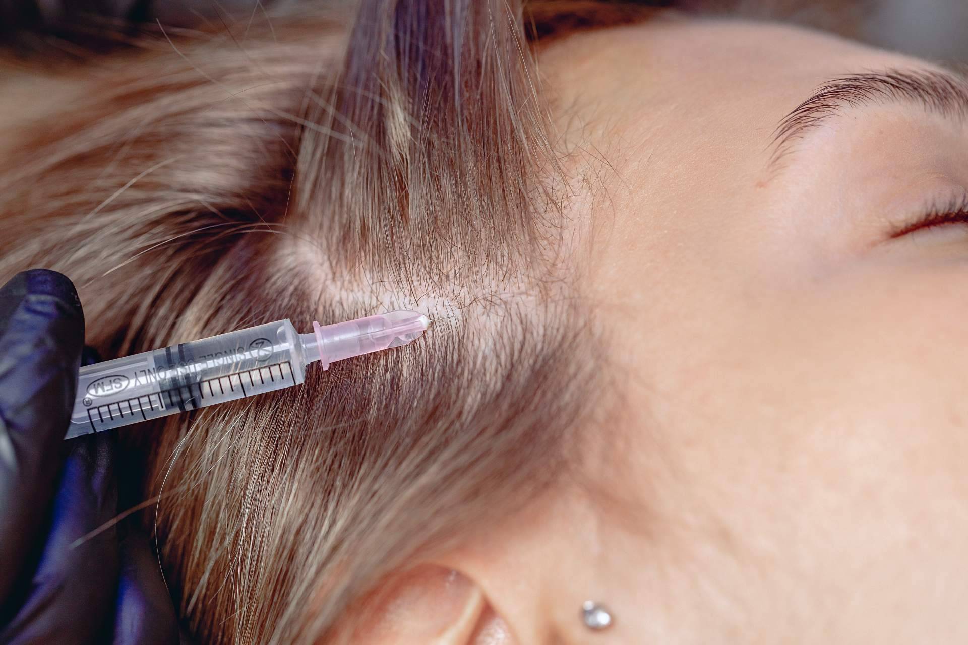 Tratamientos de mesoterapia para el cabello con Capilar Innovation Clinic, con el doctor Jesus Anibal Mora