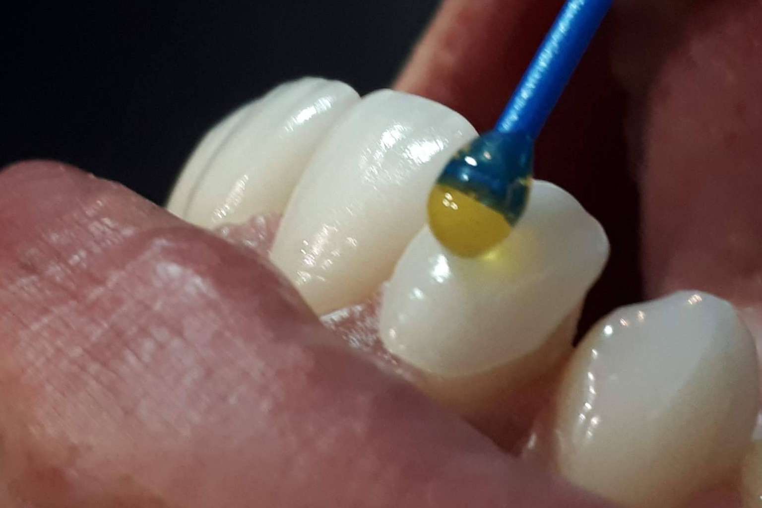 Una nueva sonrisa con carillas de cerámica