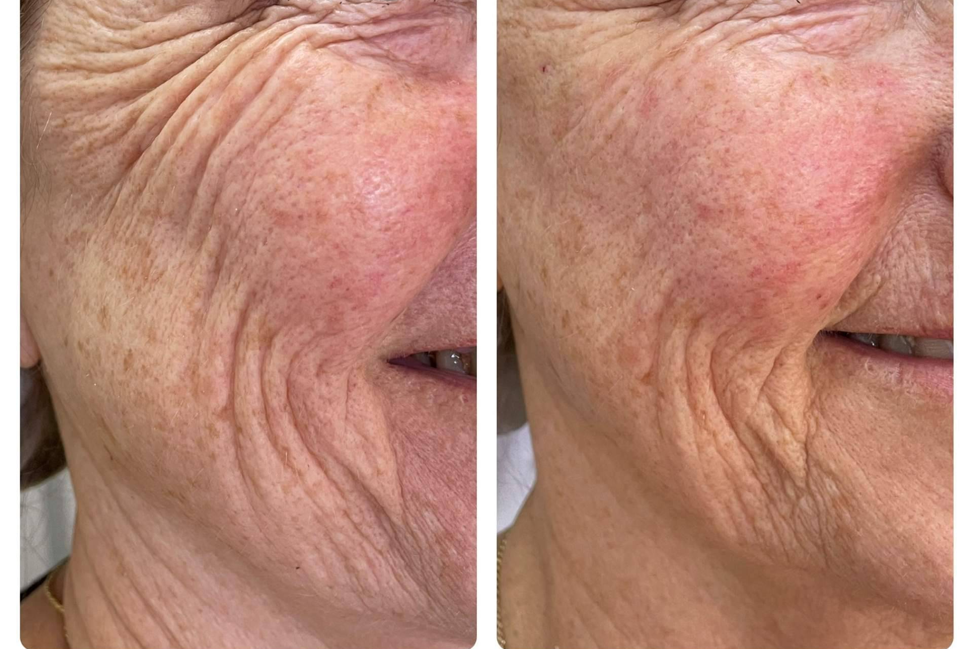 ¿Por qué el lipofilling facial gana popularidad en 2026 como alternativa al ácido hialurónico?